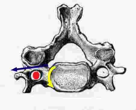 Neurocentric joint of Luschka.