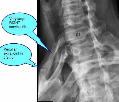 Oblique x-ray showing a very large cervical rib.