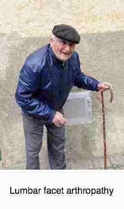 An old man with facet arthropathy. An old man with facet arthropathy.
