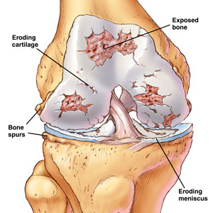 A graphic view of osteoarthritis in the knee. A graphic view of osteoarthritis in the knee.