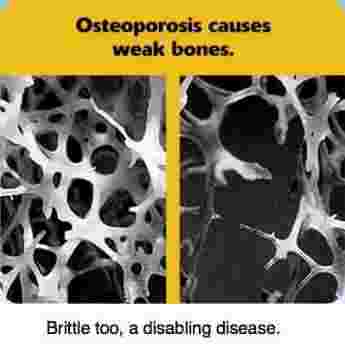 Osteoporosis weak brittle bones