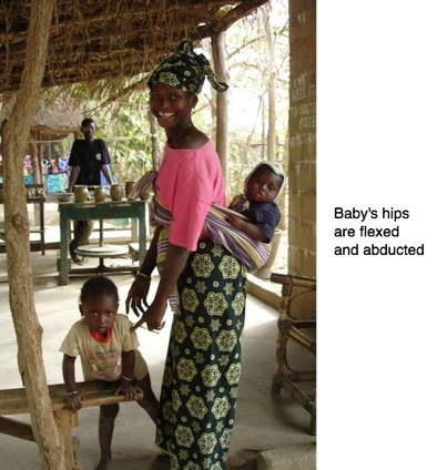 Zulu woman bearing a child in position to prevent development of hip dysplasia.