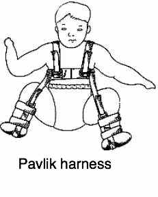 Pavlik harness. Pavlik harness.