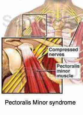 Pectoralis minor causing tingling in arms and hands. Pectoralis minor causing tingling in arms and hands.