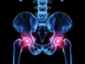Arthritis in the hip joint. Arthritis in the hip joint.