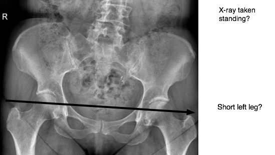 PAIN IN UPPER LEG as in this case file can be a diagnostic