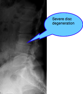 Femoro acetabular impingement syndrome pincer is a stiff hip.