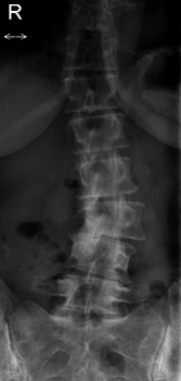 AP x-ray of a patient with both a pincer and a scoliosis. AP x-ray of a patient with both a pincer and a scoliosis.