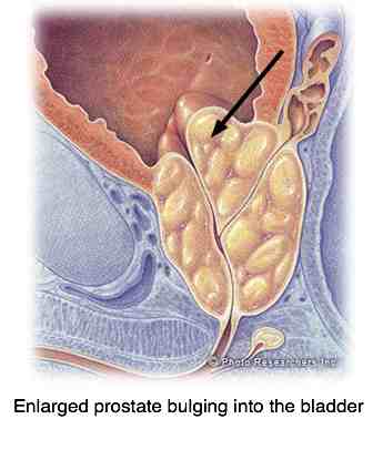 An enlarged prostrate pressing on the urethra.