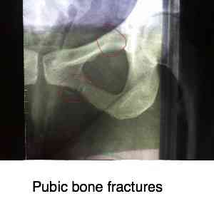 Pubic bone fracture. Pubic bone fracture.