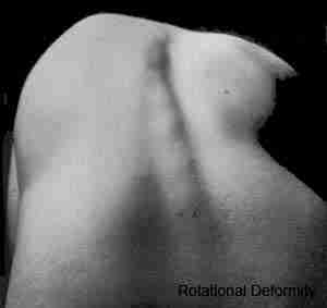 Scoliosis test Scoliosis test