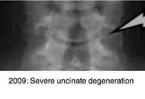 Severe uncinate degeneration arthritis. Severe uncinate degeneration arthritis.