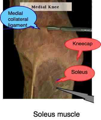 Gross anatomy photograph of the soleus muscle that causes shin splints. Gross anatomy photograph of the soleus muscle that causes shin splints.