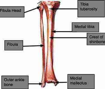 Shin splints on the tibia. Shin splints on the tibia.
