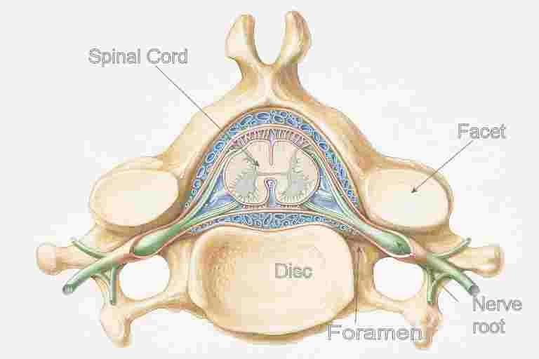 Spinal cord and vertebra is a graphic showing how spinal stenosis can cause arm and leg pain and weakness. Spinal cord and vertebra is a graphic showing how spinal stenosis can cause arm and leg pain and weakness.