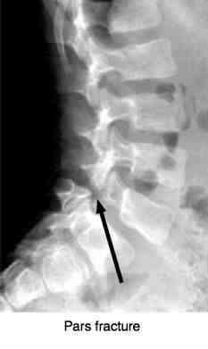 Spondylisthesis shown in an x-ray of this child's spine.