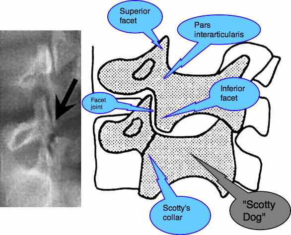 Spondylolysthesis showing fracture through the pars interarticularis and the Scotty dog.