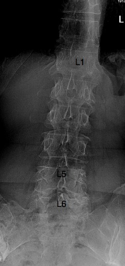 AP x-ray showing a casefile of patient G who has a spondylolysthesis.