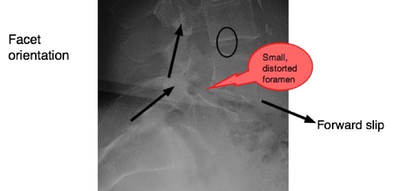 Spondylolysthesis x-ray showing change of orientation of degenerative facets.