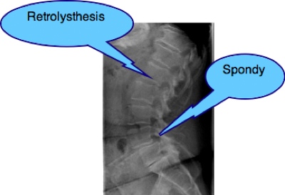 Spondylolysthesis seen on a lateral lumbar x-ray.
