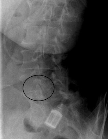 Right oblique x-ray of a spondylolysthesis.