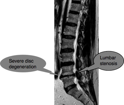 Chiropractic Help, Issue #08 - Lumbar-Stenosis