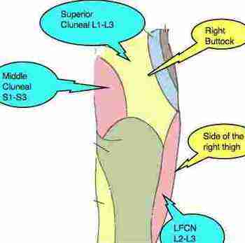 Maignes syndrome is low back pain that radiates into the buttock and