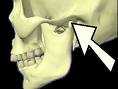 TMJ or temporo mandibular joint.