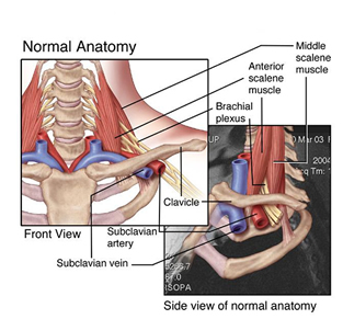 Thoracic outlet syndrome or TOS.