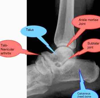 An x-ray of the lateral ankle showing the talo calcaneus joint An x-ray of the lateral ankle showing the talo calcaneus joint