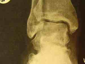 Talus fracture missed on the AP.