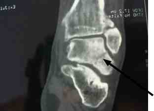 AP CT scan revealing missed fracture of talus.