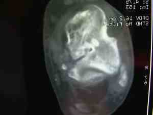 Avascular necrosis of the talus bone.