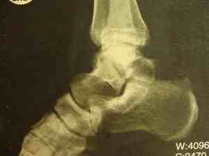 Talus fracture missed on the lateral.