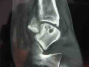 Missed talus fracture.