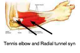 Tennis elbow ailment. Tennis elbow ailment.