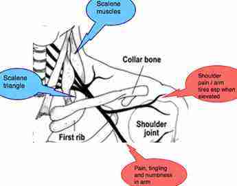 Thoracic outlet syndrome showing nerve to shoulder. Thoracic outlet syndrome showing nerve to shoulder.