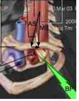 A diagram of the thoracic outlet with the interscalene triangle and the brachial plexus labelled. A diagram of the thoracic outlet with the interscalene triangle and the brachial plexus labelled.
