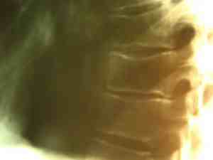 Thoracic spine fracture.