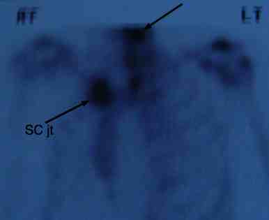 Tietze's syndrome bone scan