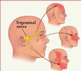 The distribution of the pain from trigeminal neuralgia and it's relationship to the TMJ.