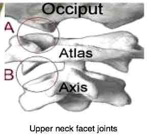 Atlanto occipital joint is a common cause of headache which