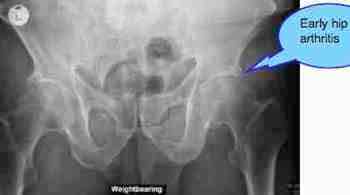 Pelvic x-ray revealing hip arthritis which may be a complicating factor in a femoral nerve case file. Pelvic x-ray revealing hip arthritis which may be a complicating factor in a femoral nerve case file.