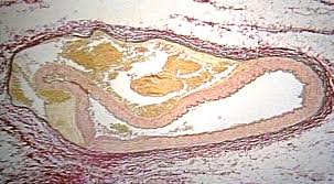 Graphic showing arterial dissection with infiltrates. Graphic showing arterial dissection with infiltrates.
