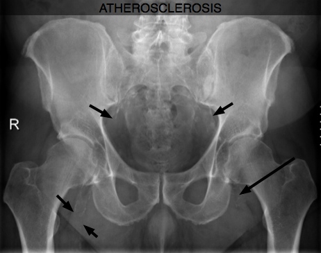 Atherosclerosis seen on an x-ray of the pelvis. Atherosclerosis seen on an x-ray of the pelvis.