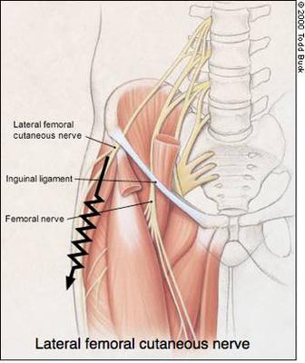 Burning on front of thigh, above knee, while sleeping - femoral nerve?