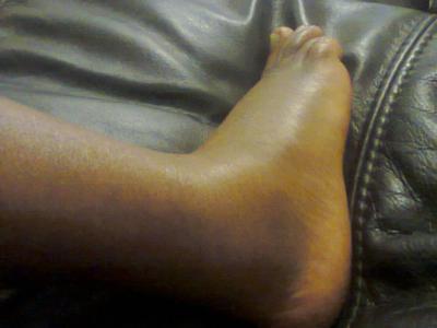 Swollen ankle