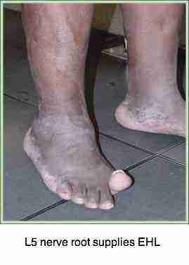 Can you raise your big toe?