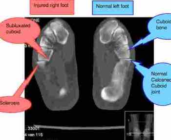 X-ray of feet
