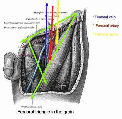 Femoral Artery stent followed by pain in back and leg